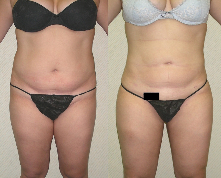 Liposuction Before and After Photo by Ganchi Plastic Surgery in Northern New Jersey