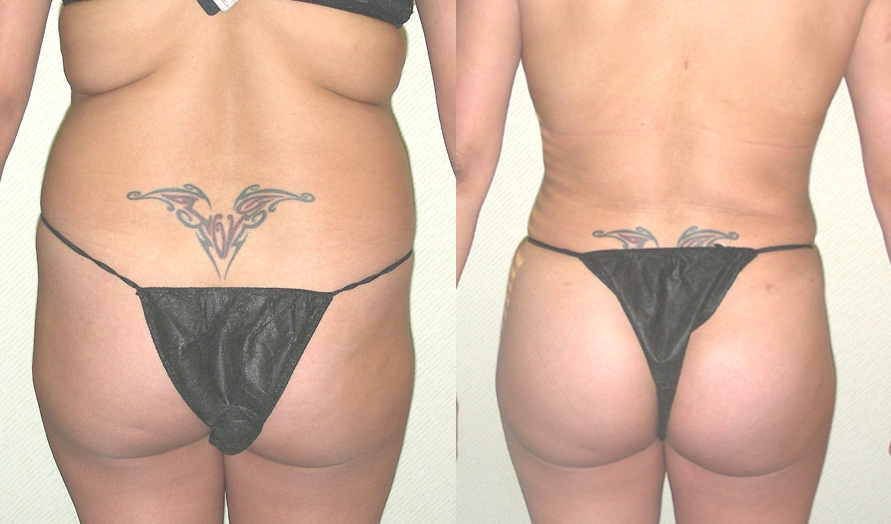 Liposuction Before and After Photo by Ganchi Plastic Surgery in Northern New Jersey