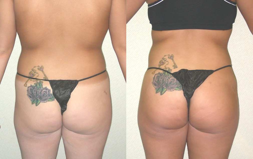 Liposuction Before and After Photo by Ganchi Plastic Surgery in Northern New Jersey