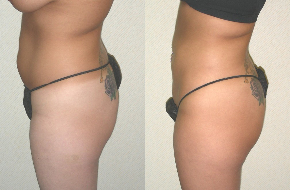 Liposuction Before and After Photo by Ganchi Plastic Surgery in Northern New Jersey