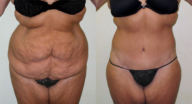 Body Lift Before and After Photo by Ganchi Plastic Surgery in Northern New Jersey