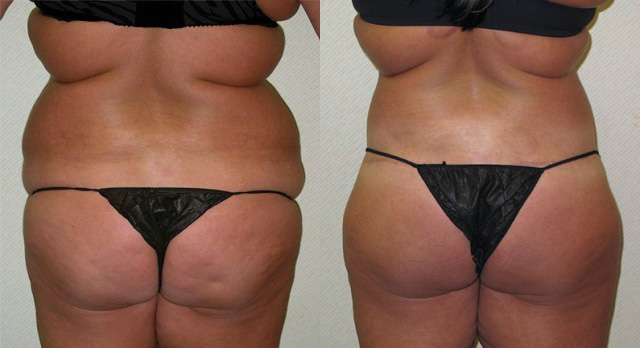 Body Lift Before and After Photo by Ganchi Plastic Surgery in Northern New Jersey