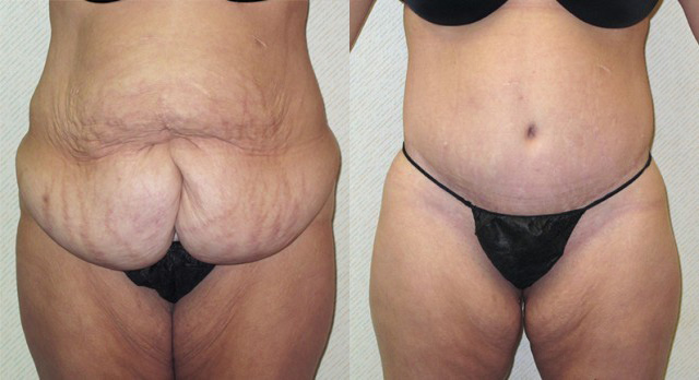 Body Lift Before and After Photo by Ganchi Plastic Surgery in Northern New Jersey