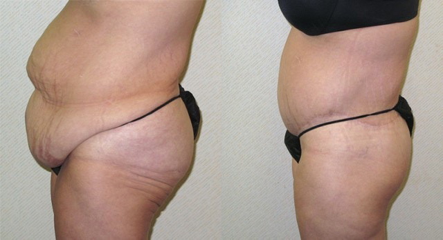 Body Lift Before and After Photo by Ganchi Plastic Surgery in Northern New Jersey