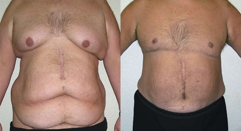 Body Lift Before and After Photo by Ganchi Plastic Surgery in Northern New Jersey