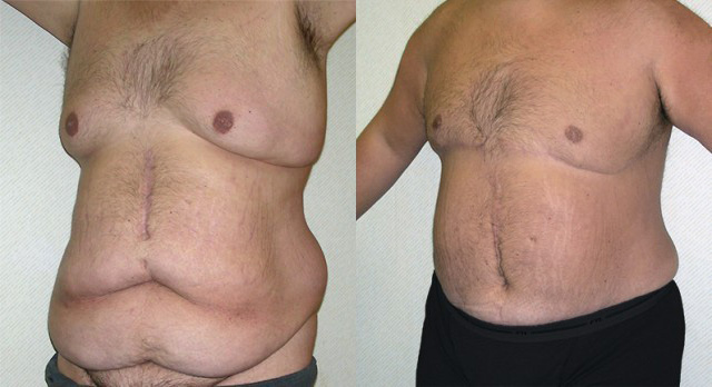 Body Lift Before and After Photo by Ganchi Plastic Surgery in Northern New Jersey
