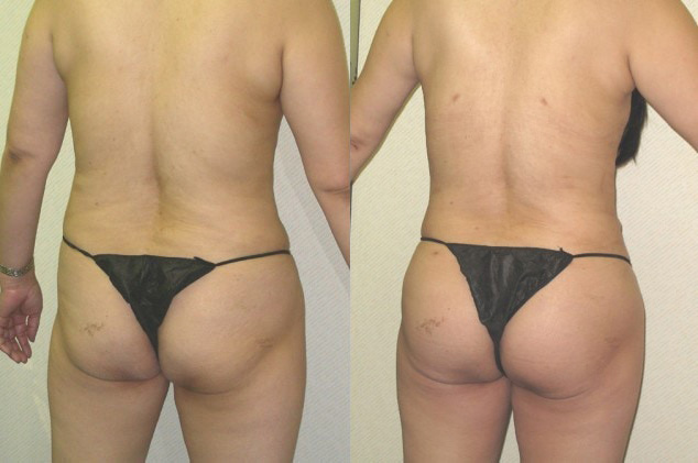 Buttock Augmentation Before and After Photo by Ganchi Plastic Surgery in Northern New Jersey