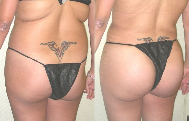 Buttock Augmentation Before and After Photo by Ganchi Plastic Surgery in Northern New Jersey