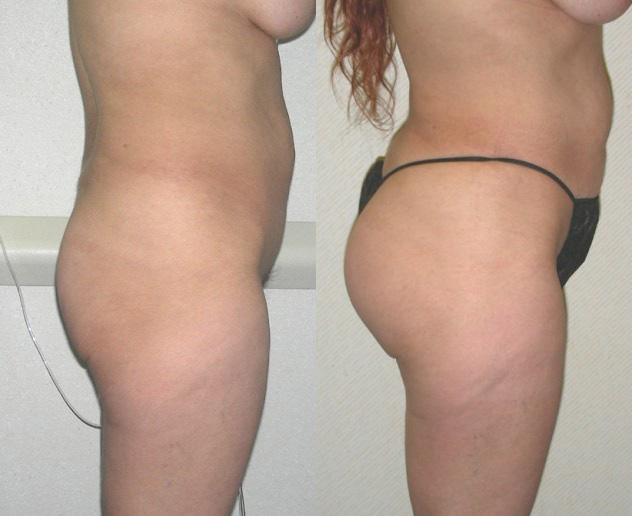 Buttock Augmentation Before and After Photo by Ganchi Plastic Surgery in Northern New Jersey