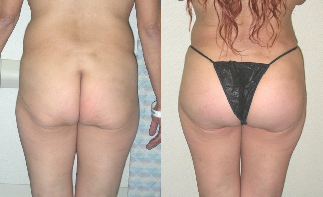 Buttock Augmentation Before and After Photo by Ganchi Plastic Surgery in Northern New Jersey