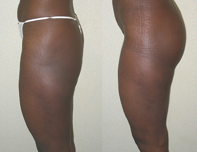 Buttock Augmentation Before and After Photo by Ganchi Plastic Surgery in Northern New Jersey