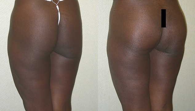 Buttock Augmentation Before and After Photo by Ganchi Plastic Surgery in Northern New Jersey