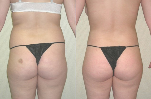 Buttock Augmentation Before and After Photo by Ganchi Plastic Surgery in Northern New Jersey