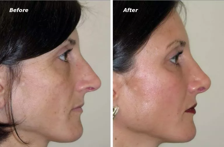 Rhinoplasty Before and After Photo by Dr. Ganchi