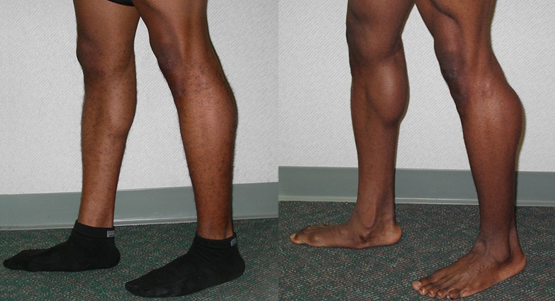 Calf Augmentation Before and After Photo by Ganchi Plastic Surgery in Northern New Jersey