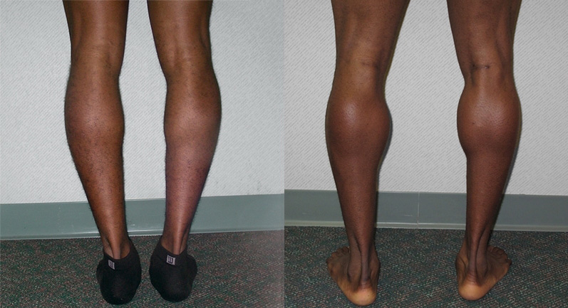 Calf Augmentation Before and After Photo by Ganchi Plastic Surgery in Northern New Jersey