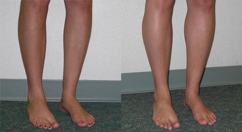 Calf Augmentation Before and After Photo by Ganchi Plastic Surgery in Northern New Jersey