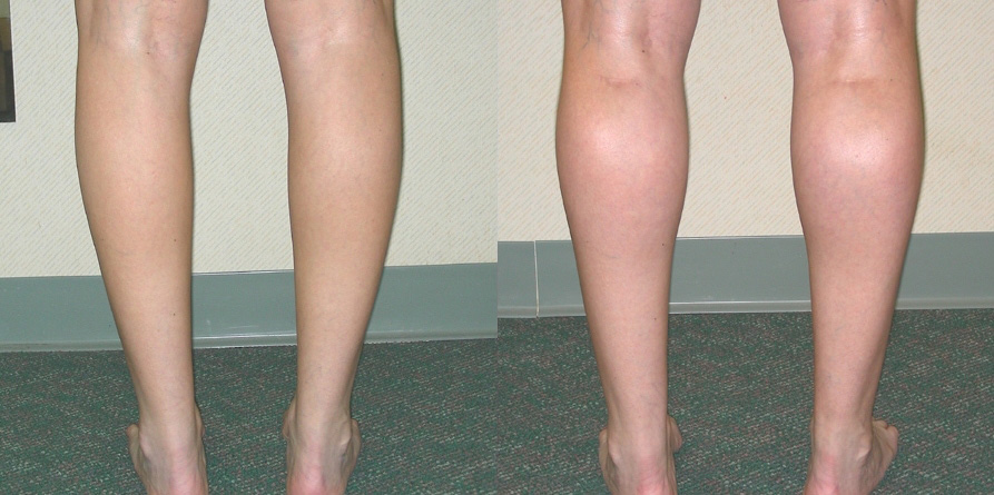 Calf Augmentation Before and After Photo by Ganchi Plastic Surgery in Northern New Jersey