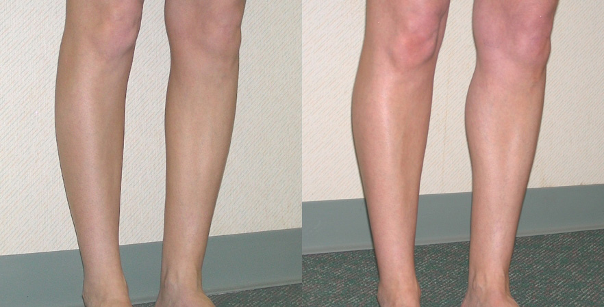 Calf Augmentation Before and After Photo by Ganchi Plastic Surgery in Northern New Jersey