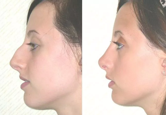 Rhinoplasty by Dr. Ganchi