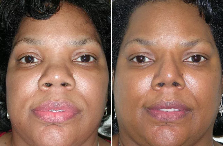 Rhinoplasty Before and After Photo by Dr. Ganchi