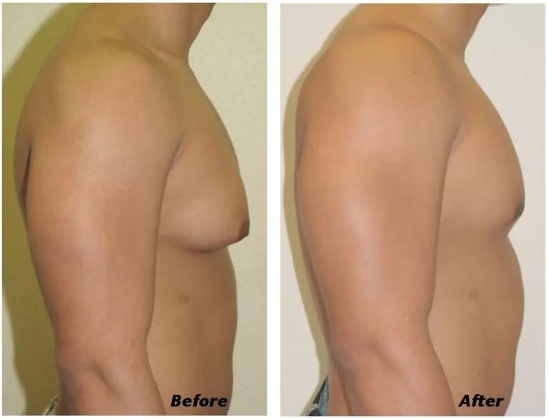Gynecomastia performed by Ganchi Plastic Surgery Before and After Results