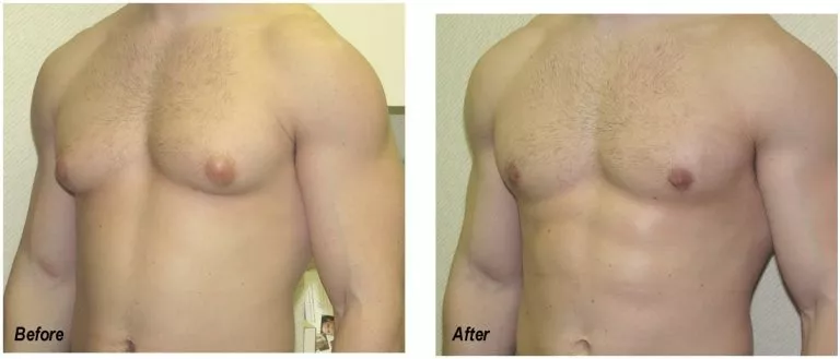 Gynecomastia performed by Ganchi Plastic Surgery Before and After Results