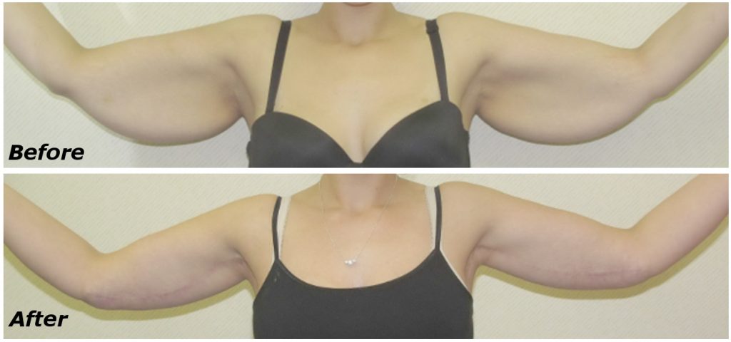 Arm Lift Procedure Before and After Photos by Ganchi Plastic Surgery