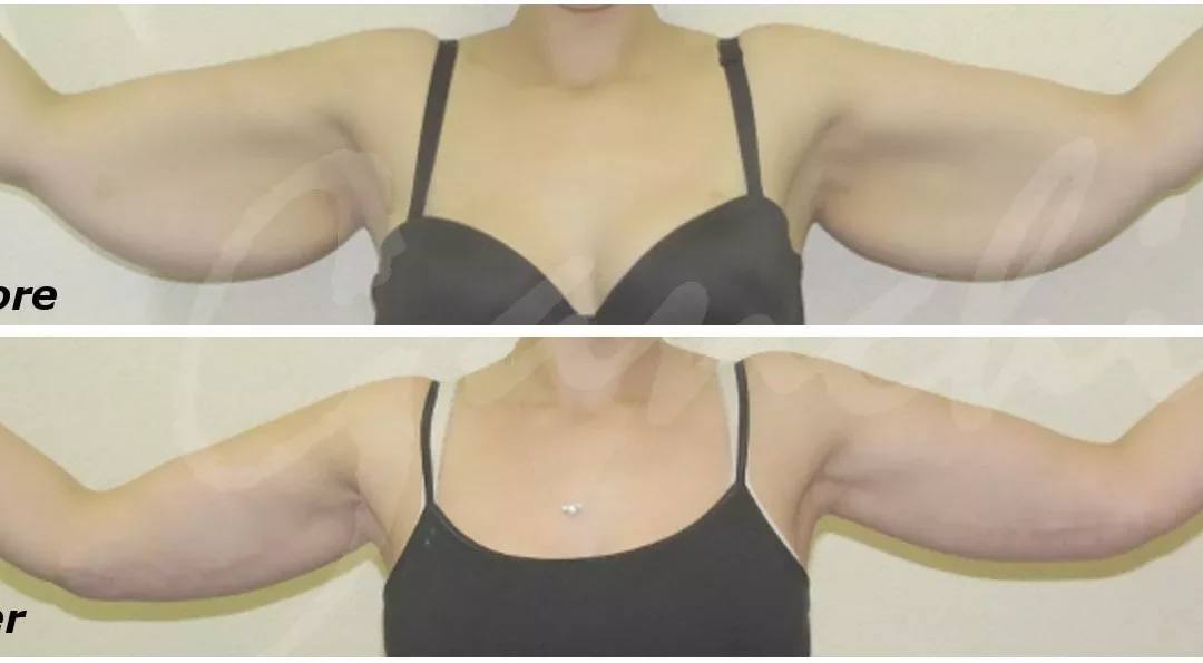 Arm Lift Surgery For Flabby Arms