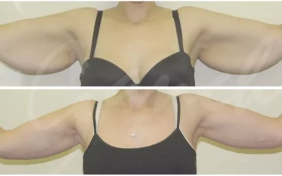 Arm Lift Surgery For Flabby Arms