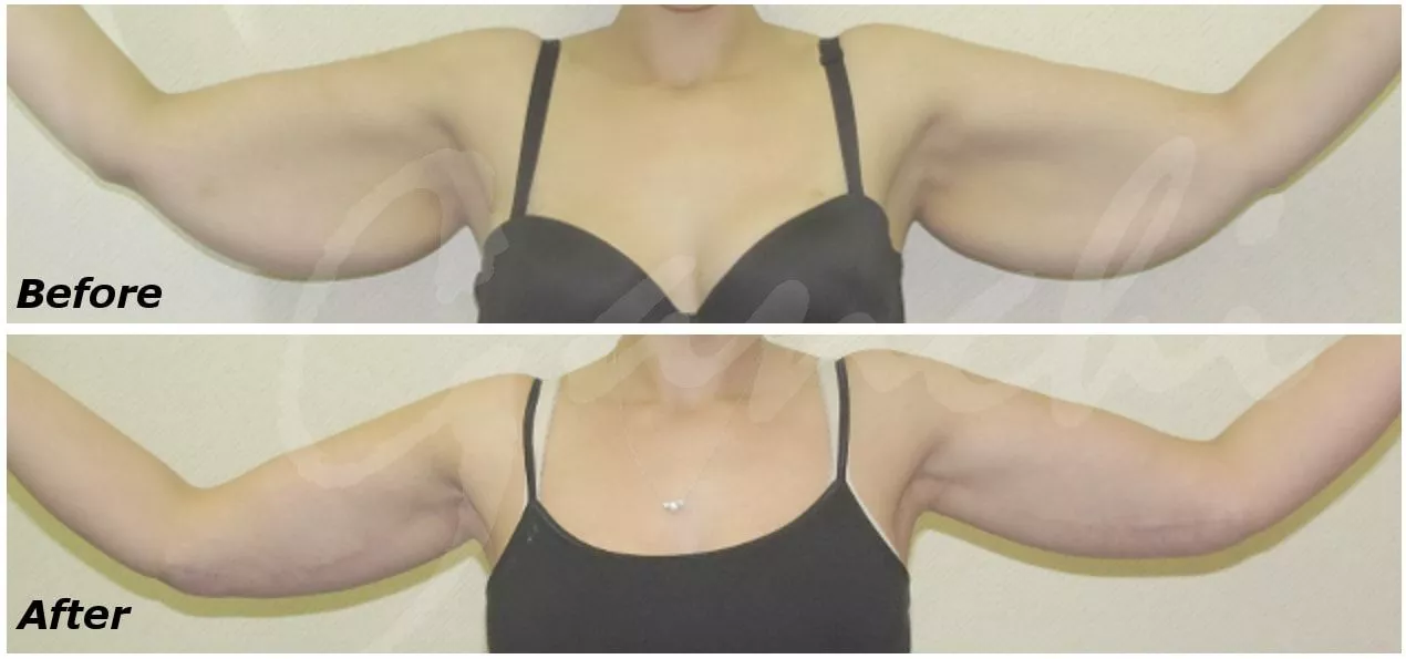 Arm Lift Before and After Photo by Ganchi Plastic Surgery in Northern New Jersey