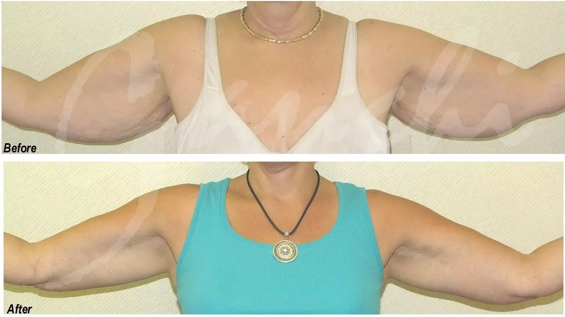 Arm Lift Surgery for flabby arms by Ganchi Plastic Surgery in Northern New Jersey