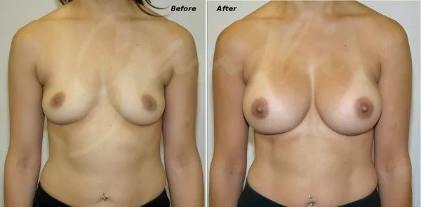 Cosmetic breast augmentation with silicone breast implants Before and After Photo by Ganchi Plastic Surgery in Northern New Jersey