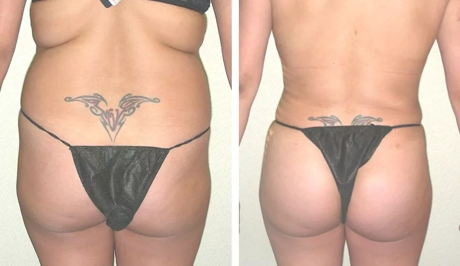 Brazilian Butt Lift fat transfer Before and After Photo by Ganchi Plastic Surgery in Northern New Jersey