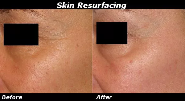Fractional Laser Resurfacing Before and After Photo by Ganchi Plastic Surgery in Northern New Jersey