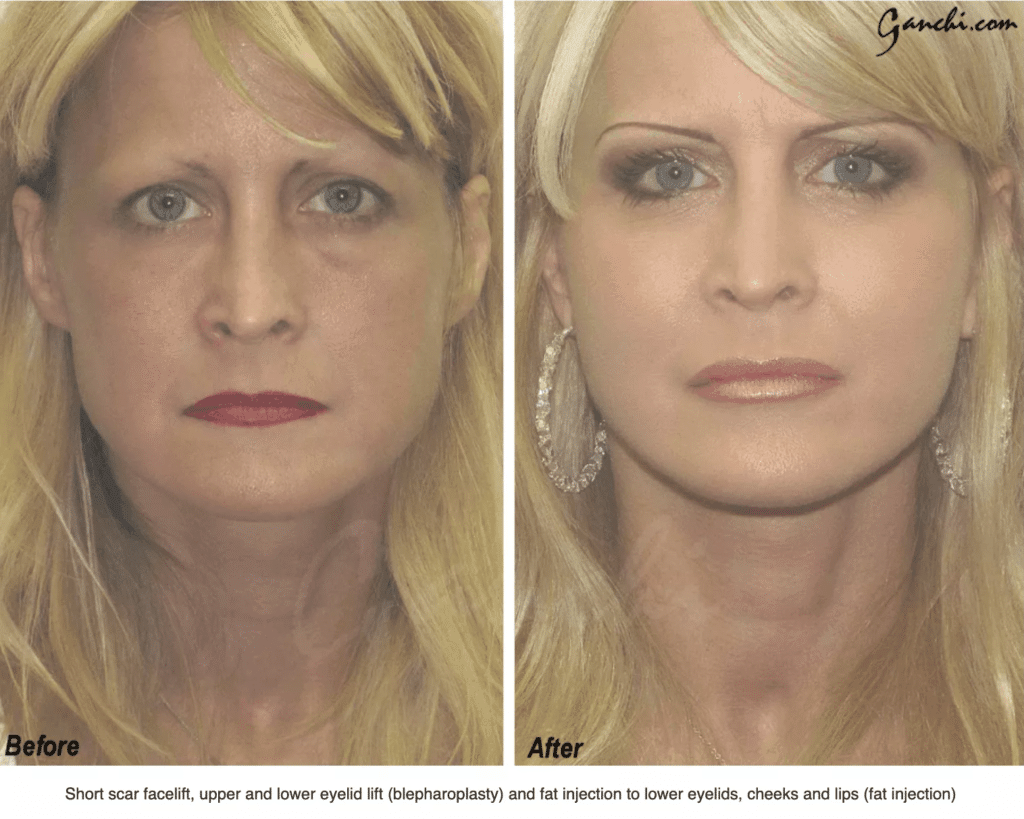 lipo c injection dosage per day reddit NAD Dosage Chart & NAD Dosage Per Day