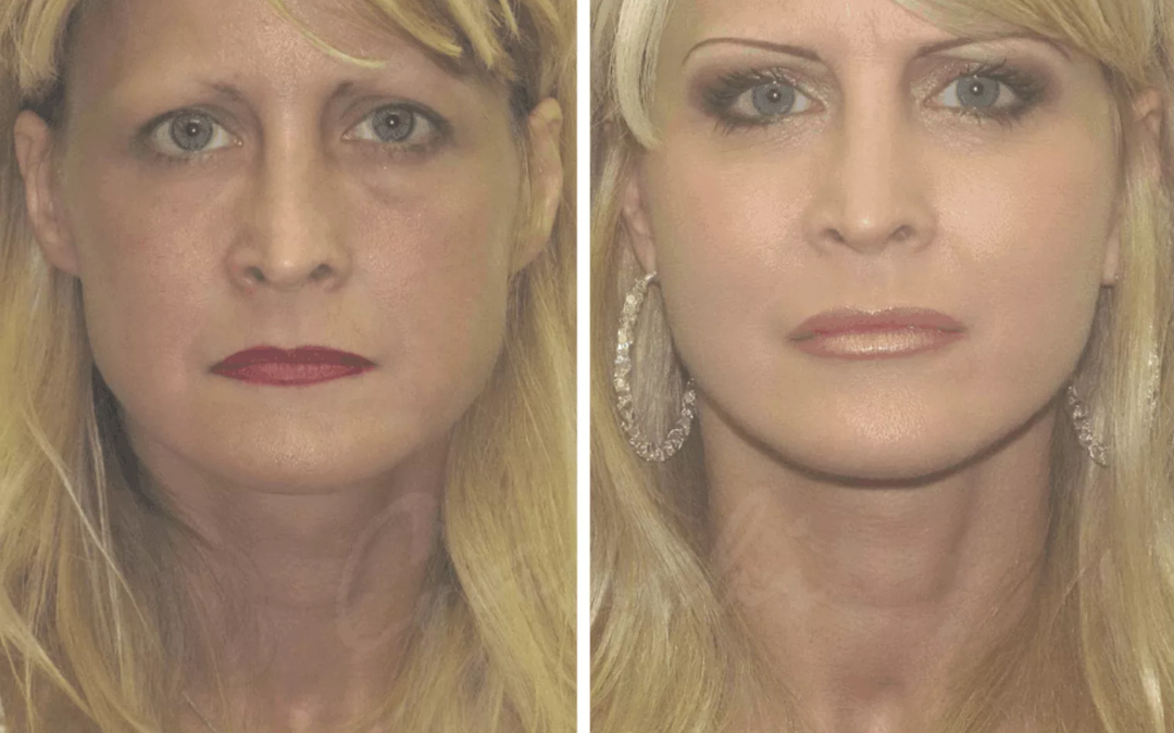 Facelift Surgery Recovery: Tips to Help You Heal