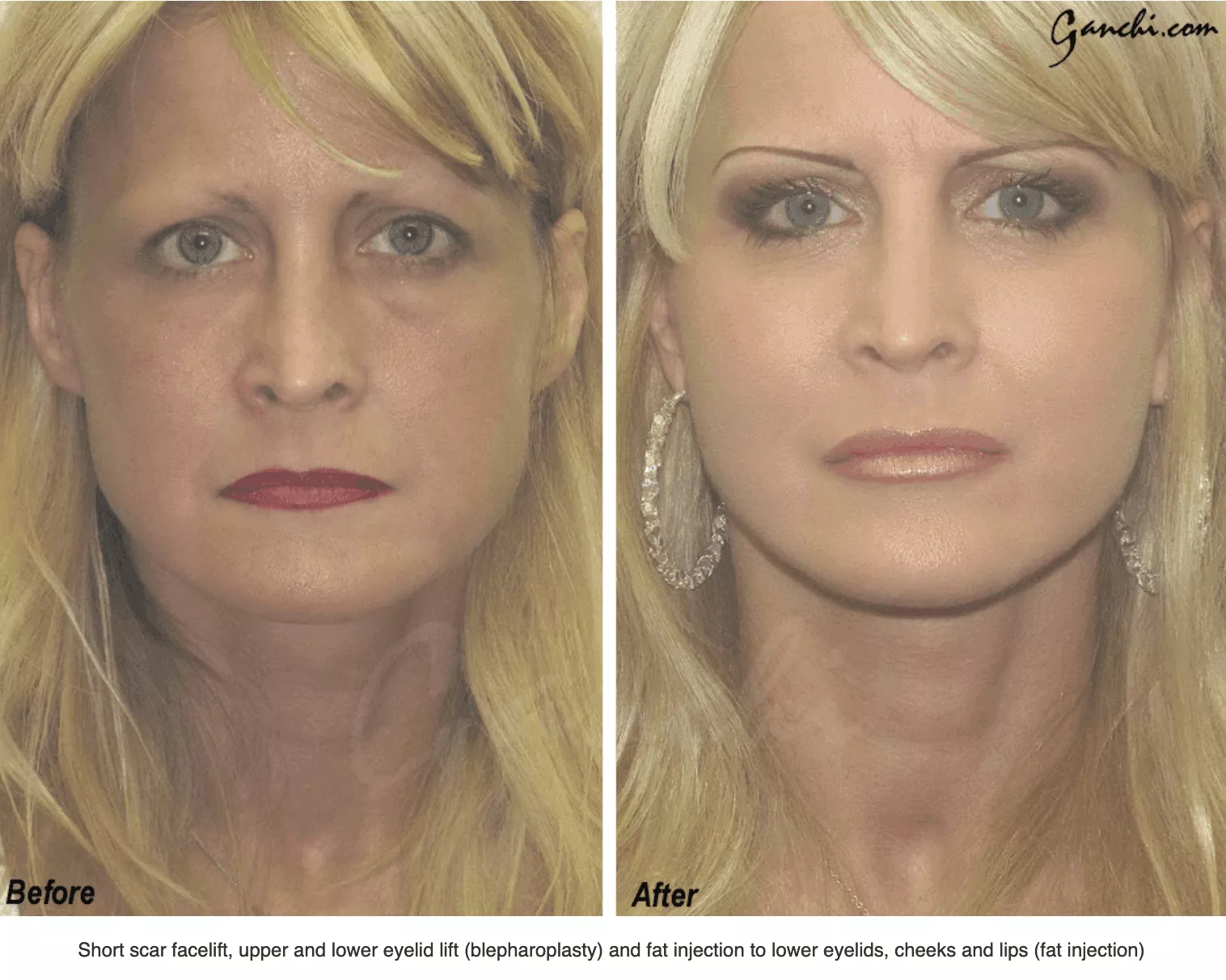 Facelift Recovery Wayne, NJ  Ganchi Plastic Surgery New Jersey