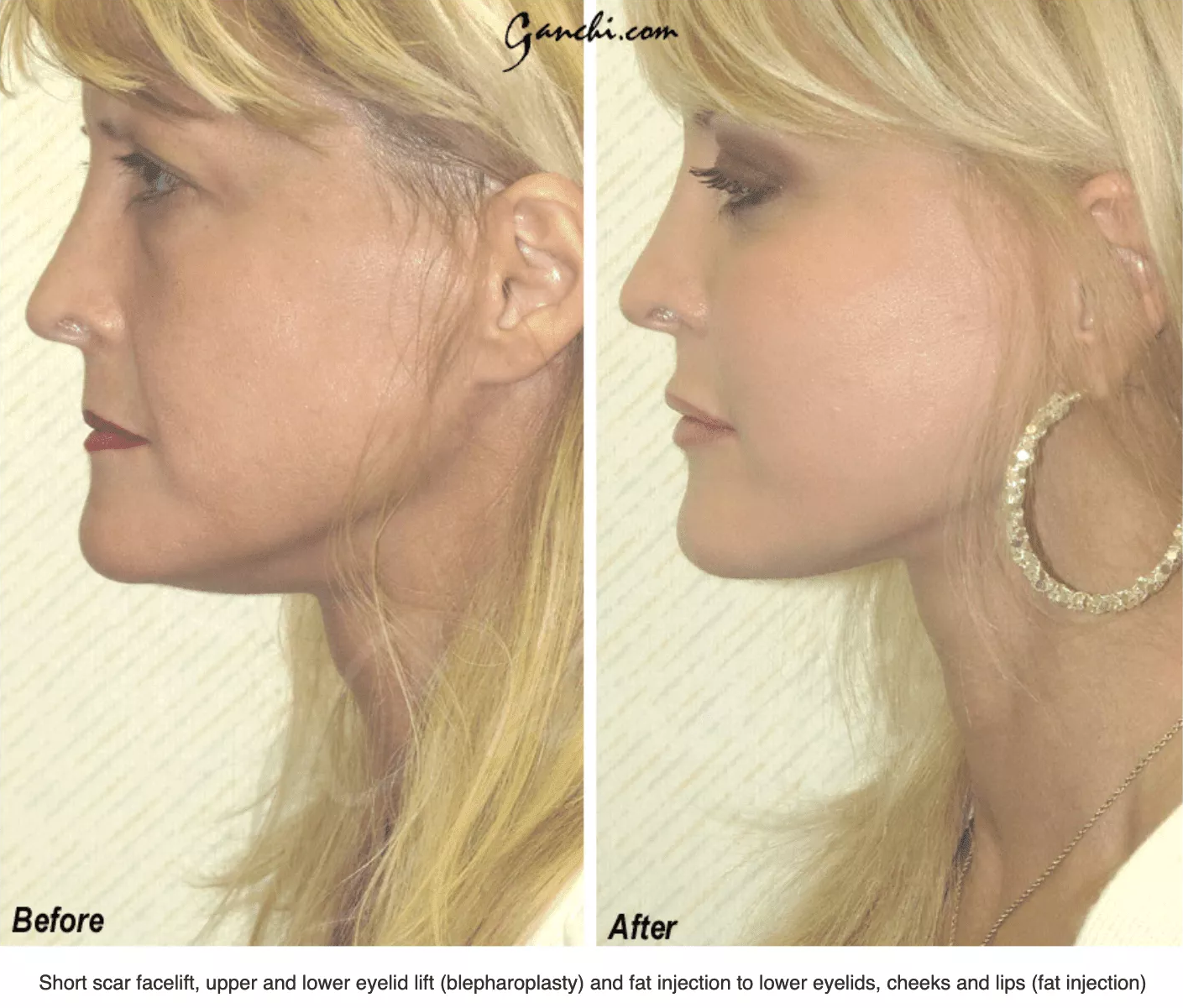 Facelift recovery in NJ