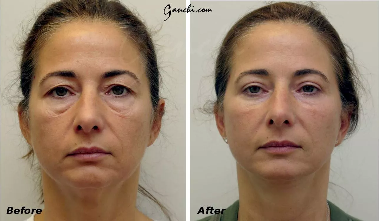 Face and Neck lift Before and After Photo by Ganchi Plastic Surgery in Northern New Jersey