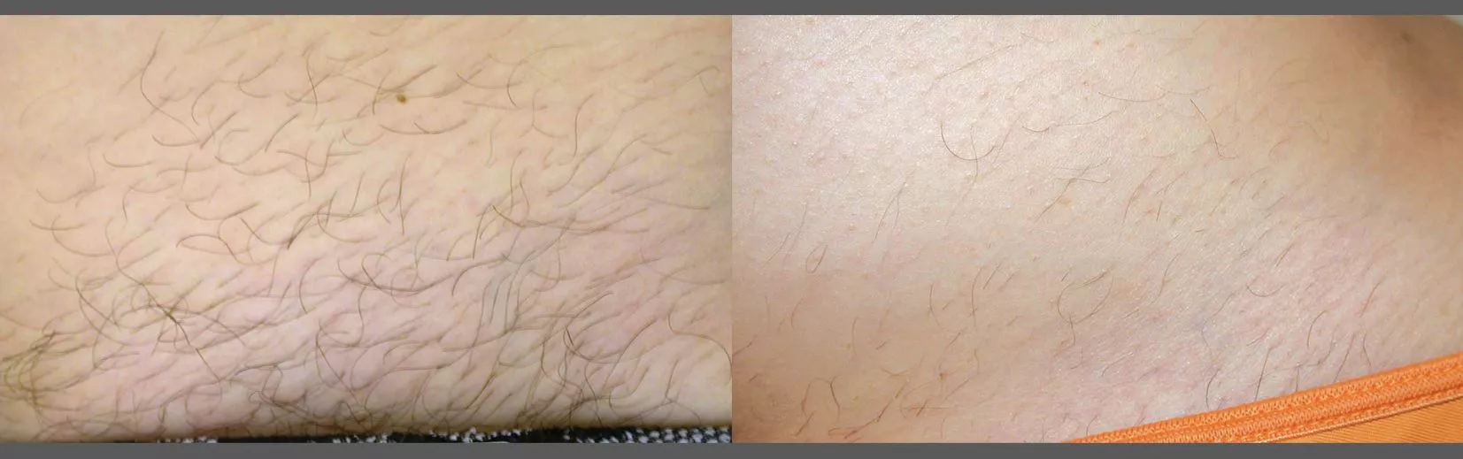 Hair Removal on legs