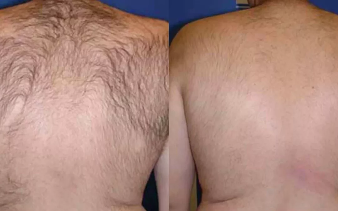 Laser Hair Removal in New Jersey