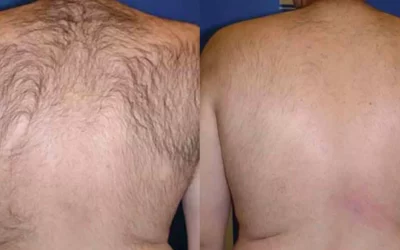 Laser Hair Removal