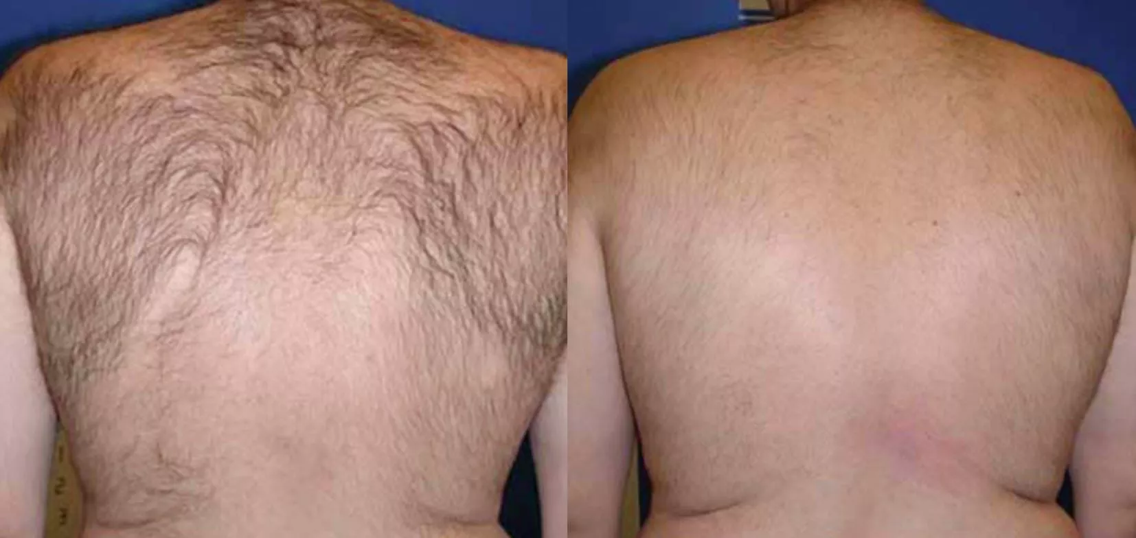 Laser Hair Removal Before and After Photo by Ganchi Plastic Surgery in Northern New Jersey