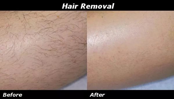 Hair Removal Before and After Photo by Ganchi Plastic Surgery in Northern New Jersey