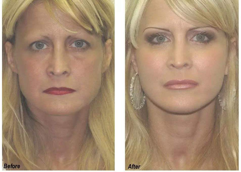 Lip Augmentation Before and After Photo by Ganchi Plastic Surgery in Northern New Jersey