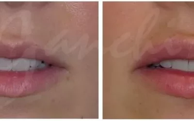 The Best Lip Injections & Fillers in NJ