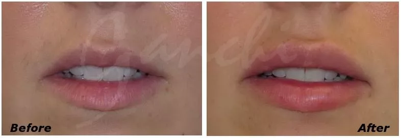 Lip fillers - Lip augmentation Before and After Photo by Ganchi Plastic Surgery in Northern New Jersey