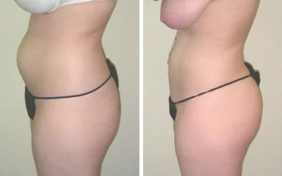 Abdominal Liposuction and Tummy Tuck – What’s the Difference?