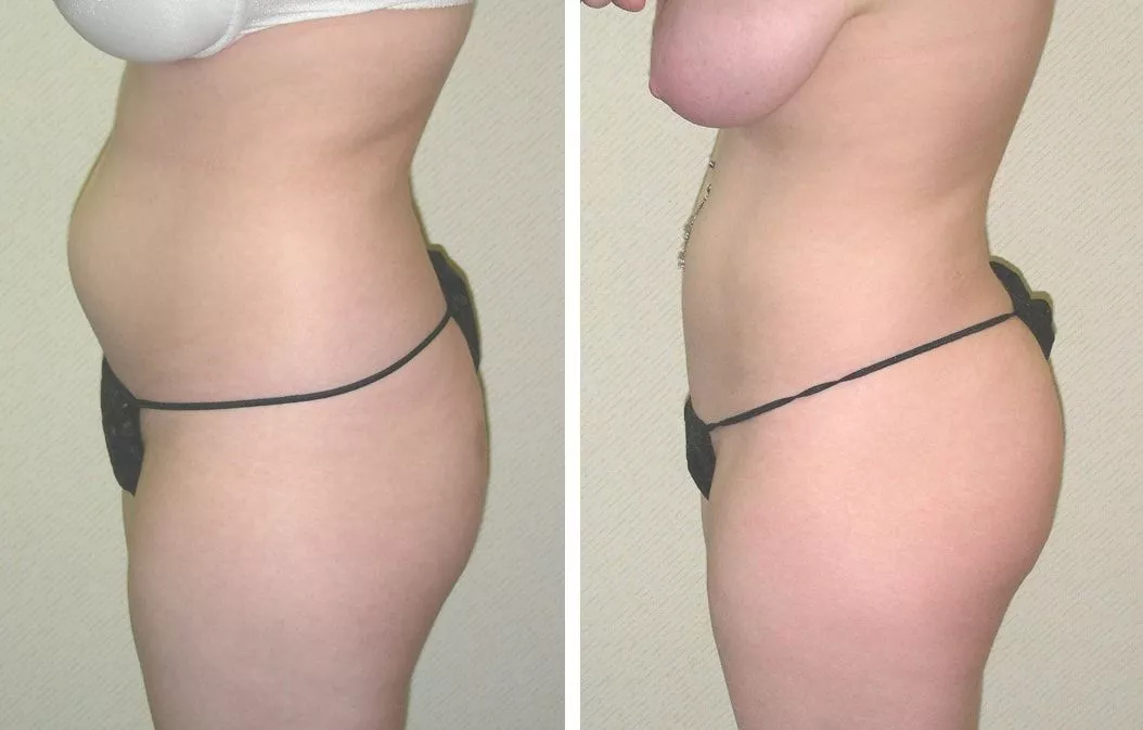 https://www.ganchi.com/wp-content/uploads/2022/01/Liposuction-02b1.webp